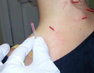Neck needles